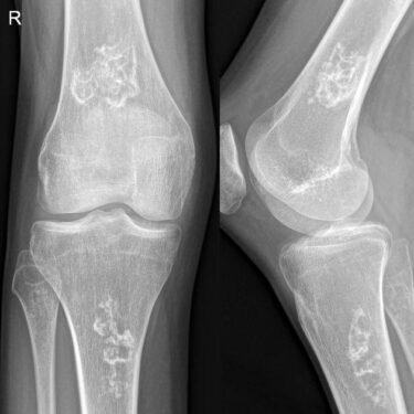 سکته استخوانی